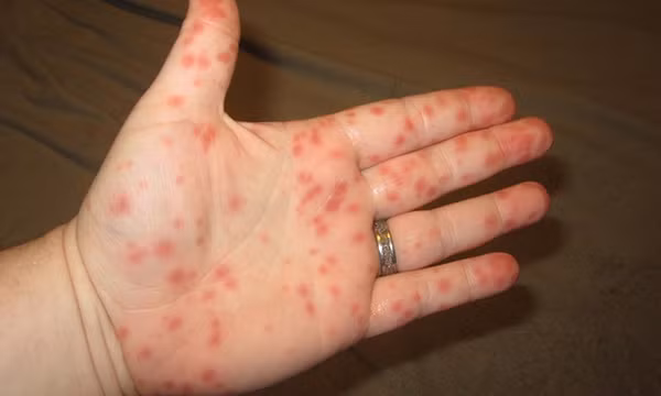 Chile cảnh báo số ca nhiễm virus Hanta gia tăng với tỷ lệ tử vong cao