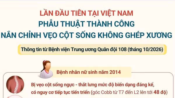 Phẫu thuật thành công nắn chỉnh vẹo cột sống không ghép xương