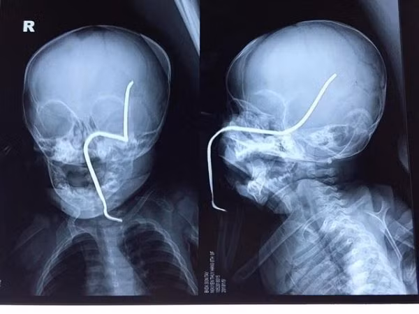 Một bé gái bị thanh sắt rỉ đâm thủng sọ ảnh 1