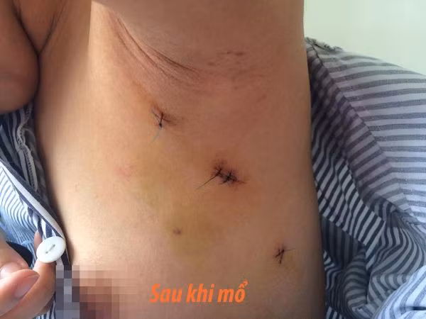Ca mổ nội soi u xơ tuyến vú bằng phương pháp ‘Dr Luong’ đầu tiên thành công ảnh 1