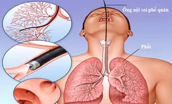 Tử vong sau khi nội soi phế quản do ngừng tuần hoàn ảnh 1