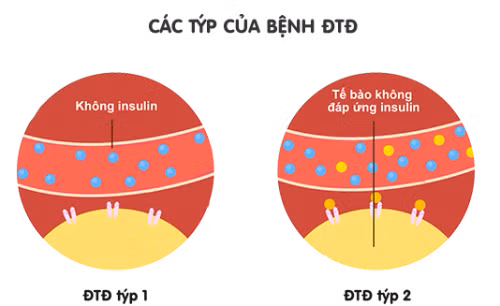Chế độ ăn uống và bệnh đái tháo đường ảnh 2