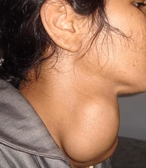 Khám, tư vấn miễn phí cho người bị bướu giáp nhân ảnh 1