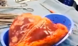 Trái tim người nghiện cocaine đập 25 phút ngoài lồng ngực