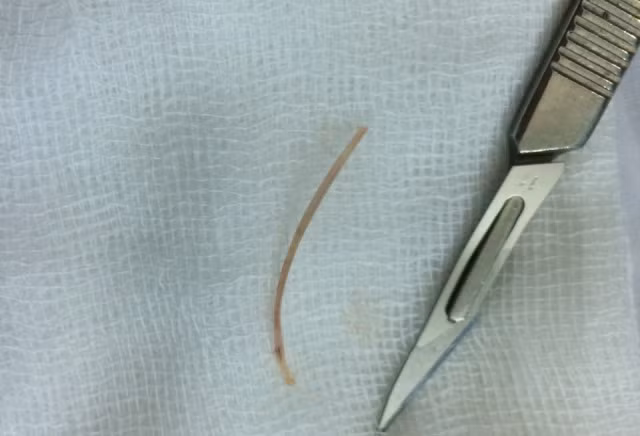Bị thủng ruột gây áp xe do nuốt tăm xỉa răng và xương cá ảnh 2