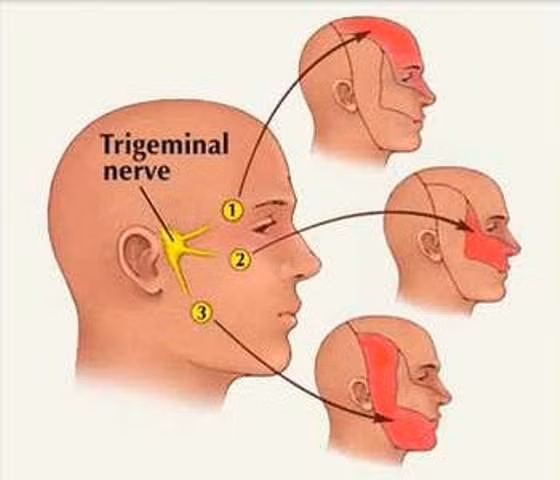 Hướng điều trị mới cho bệnh nhân đau dây thần kinh "tam thoa" ảnh 1