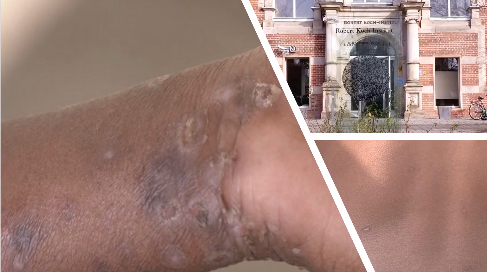 Đức đối mặt rủi ro sức khỏe cộng đồng như thế nào sau khi phát hiện ca mpox biến thể mới đầu tiên