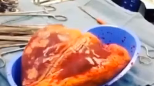 Trái tim người nghiện cocaine đập 25 phút ngoài lồng ngực