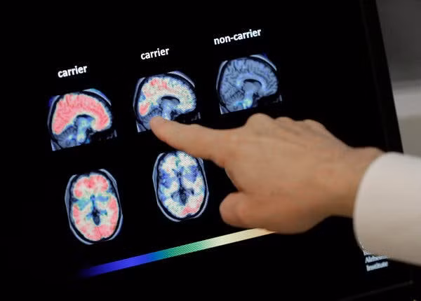 Loại thuốc đầu tiên có thể làm chậm bệnh Alzheimer