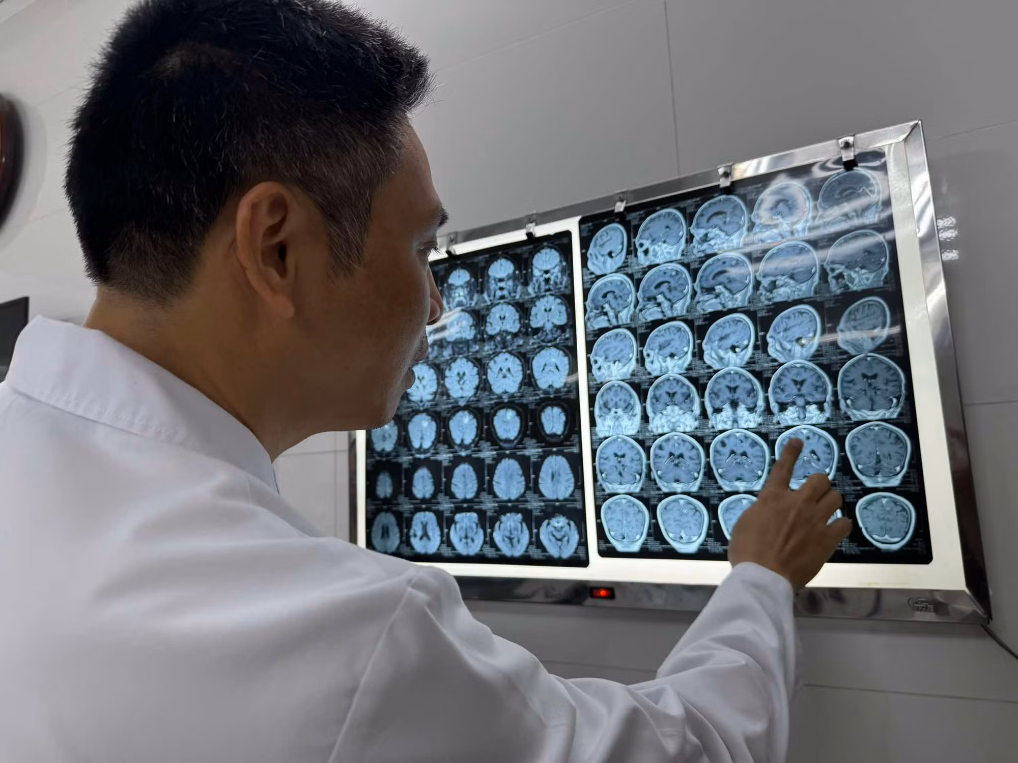 Gia tăng người bệnh bị sán làm tổ trong não