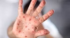 Anh ghi nhận ca tử vong đầu tiên ở người lớn do mắc sởi