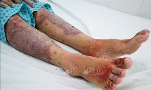 Hoại tử thượng bì nhiễm độc nặng do lạm dụng thực phẩm chức năng