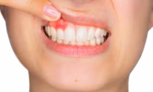 Bệnh nha chu âm thầm đe dọa sức khỏe răng miệng