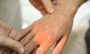 Đà Nẵng: Số ca sốt xuất huyết tăng nhanh, tiềm ẩn nhiều trường hợp biến chứng nặng