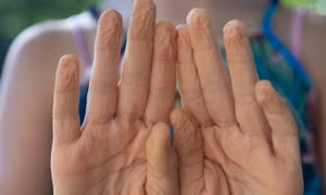 Phát hiện bất ngờ về hiện tượng ngón tay nhăn nheo khi ngâm nước