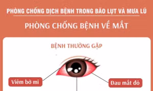 Phòng chống bệnh về mắt trong mùa bão lụt và mưa lũ