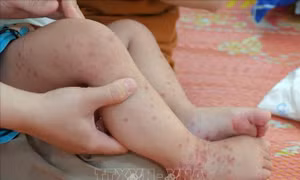 Một số địa phương ghi nhận ca mắc sốt xuất huyết và tay chân miệng chuyển nặng