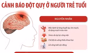 Cảnh báo đột quỵ ở người trẻ tuổi