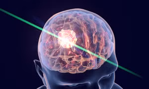 Tia laser giúp bệnh nhân ung thư não kéo dài cuộc sống