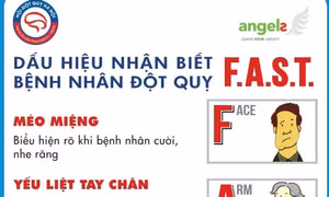 Giành giật sự sống trong thời gian vàng cho bệnh nhân bị đột quỵ não