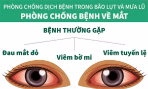 Phòng chống bệnh về mắt trong mùa bão lụt và mưa lũ