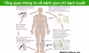 Việt Nam được công nhận loại trừ bệnh giun chỉ bạch huyết