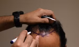 Cấy tóc gây chết chóc tại Ấn Độ