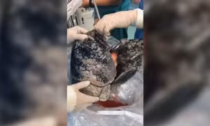 Video gây sốc lá phổi đen như than của người đàn ông nghiện thuốc lá 30 năm