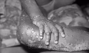 Trung Quốc đưa bộ xét nghiệm đậu mùa khỉ vào thị trường