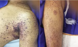 Hai người đàn ông nguy kịch do nhiễm khuẩn liên cầu lợn