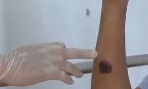 Chủ động phòng, chống bệnh than xuyên biên giới