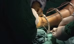 Phẫu thuật kéo chân để tăng chiều cao có đáng để mạo hiểm?