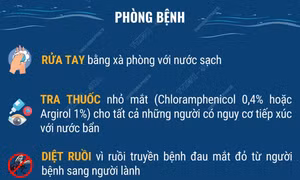 Phòng chống bệnh về mắt trong mùa bão lụt và mưa lũ