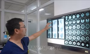 Cứu sống bệnh nhi xuất huyết não ở trẻ do dị dạng mạch máu 