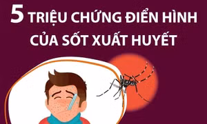 5 triệu chứng điển hình của sốt xuất huyết