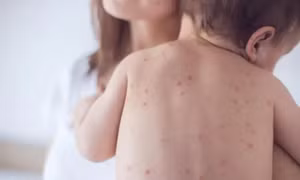 WHO cảnh báo nguy cơ bùng phát dịch sởi tại Anh