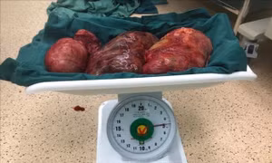 Phẫu thuật cắt khối u xơ nặng gần 5 kg ở bệnh nhân 56 tuổi