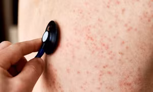 Quảng Nam: Triển khai nhanh giải pháp phòng, chống dịch sốt phát ban