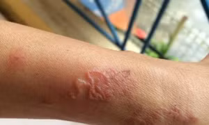 Mắc giun đũa chó mèo từ chó nuôi trong nhà