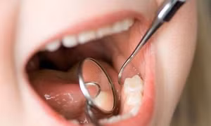Hy hữu răng sữa rơi vào phổi khi tự nhổ răng tại nhà