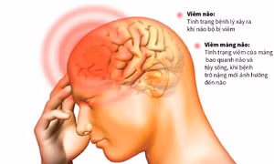 Phòng tránh bệnh viêm não và viêm màng não