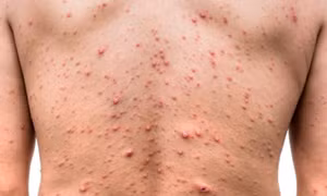 Giám sát, phát hiện sớm ổ dịch thủy đậu, không để lây lan trong cộng đồng