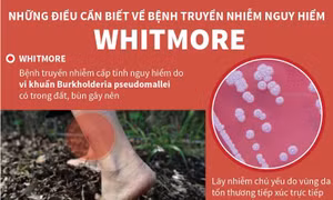 Những điều cần biết về bệnh truyền nhiễm nguy hiểm Whitmore