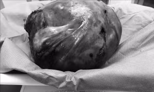 Bóc tách thành công khối u xơ tử cung hơn 4 kg