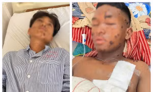 Nổ mìn tự chế khi đi đánh cá, hai thiếu niên bị thương nặng