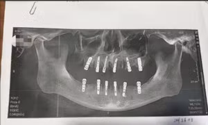 Người đàn ông tử vong sau khi nhổ 23 chiếc răng và trồng 12 răng giả cùng lúc