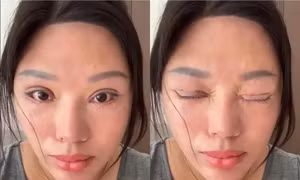 Sáu năm không nhắm được mắt khi ngủ sau khi cắt mí tại cơ sở 'chui'