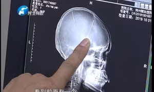 Phát hiện 2 chiếc kim cắm sâu trong não