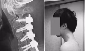 Thanh niên 25 tuổi mắc 'hội chứng cúi đầu' hiếm gặp vì nhìn điện thoại quá nhiều