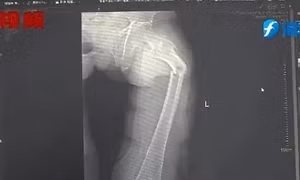 Người đàn ông 35 tuổi bị gãy xương cứng nhất cơ thể trong một cơn ho dữ dội